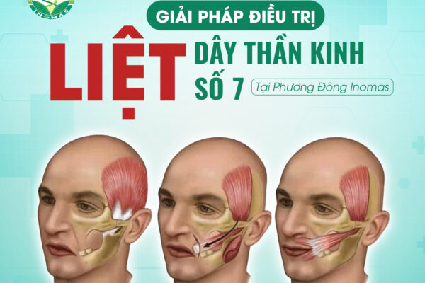 Giải Pháp Điều Trị Liệt Dây Thần Kinh Số 7 Tại Phương Đông Inomas