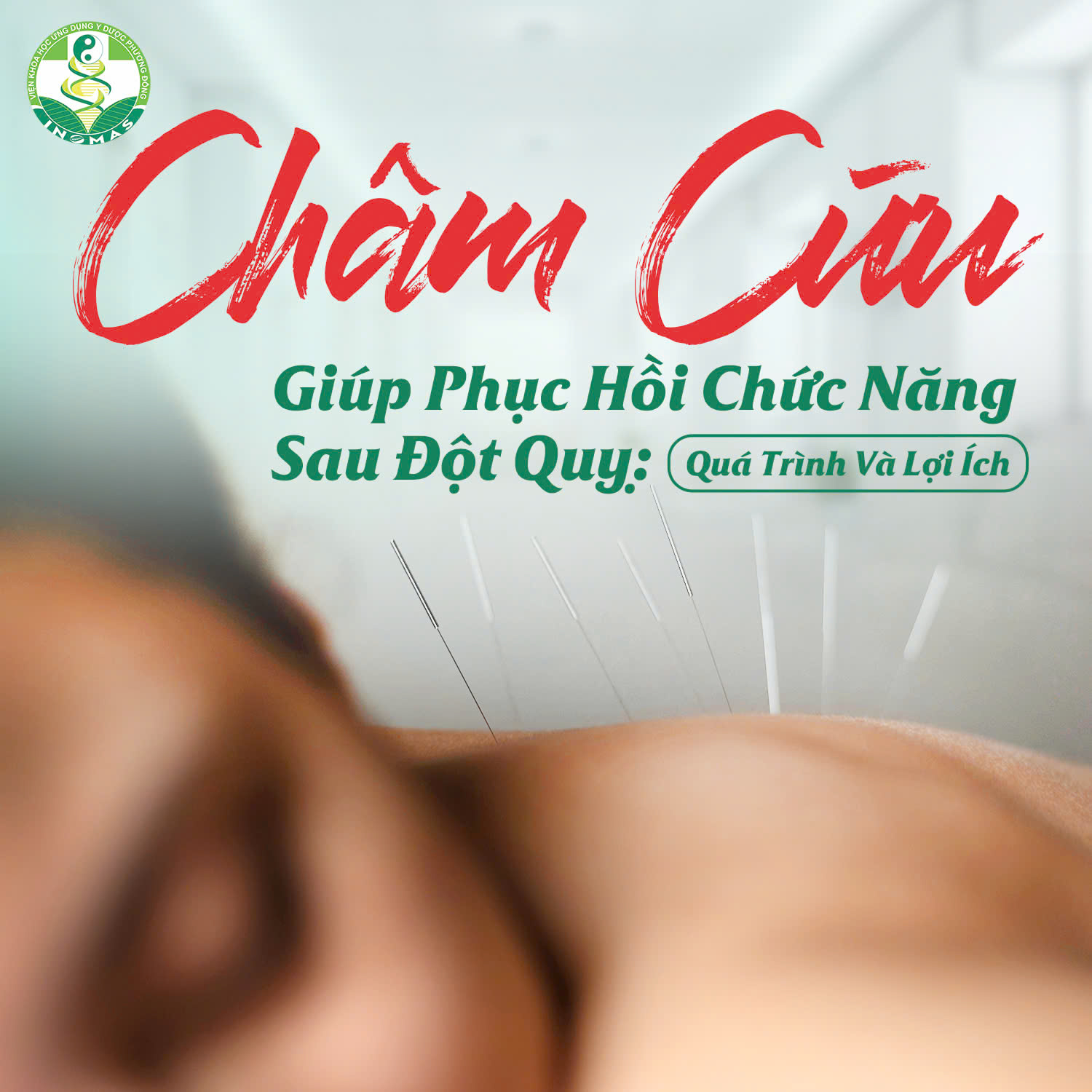 Châm Cứu: Giải Pháp Phục Hồi Chức Năng Sau Đột Quỵ Tại Phương Đông Inomas