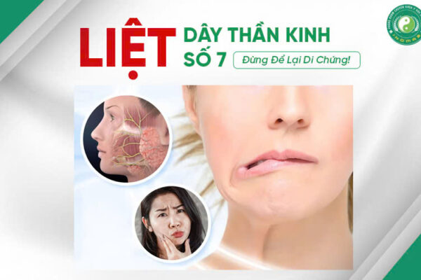 Liệt Dây Thần Kinh Số 7 – Đừng Để Lại Di Chứng!