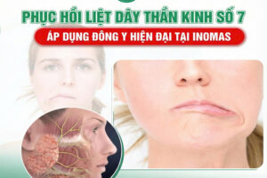 Điều trị liệt dây thần kinh số 7 bằng châm cứu chuyên sâu tại Inomas – Phục hồi vận động cơ mặt tự nhiên