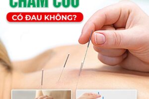 CHÂM CỨU CÓ ĐAU KHÔNG? – PHÒNG KHÁM CHUYÊN KHOA YHCT INOMAS PHƯƠNG ĐÔNG GIẢI ĐÁP