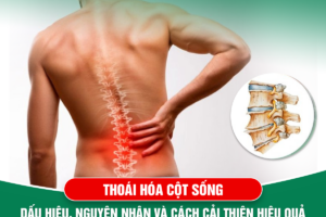 Thoái Hóa Cột Sống: Nguyên Nhân Và Cách Cải Thiện Hiệu Quả