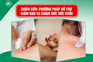 Châm Cứu: Phương Pháp Hỗ Trợ Giảm Đau