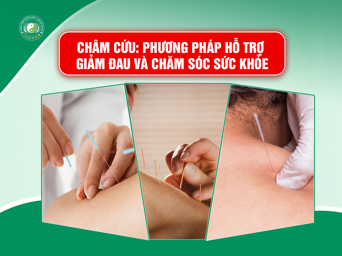 Châm Cứu: Phương Pháp Hỗ Trợ Giảm Đau