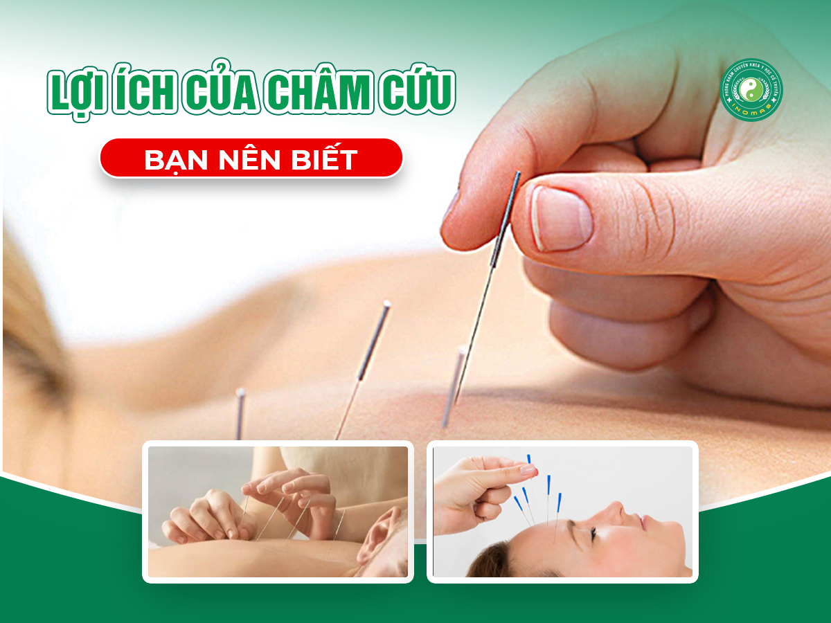 Châm Cứu: Phương Pháp Hỗ Trợ Giảm Đau