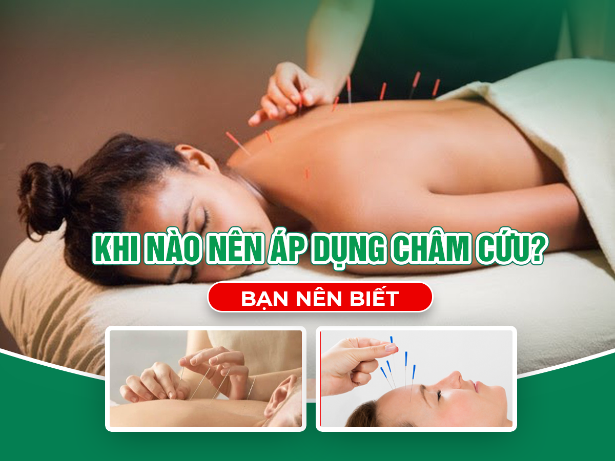 Châm Cứu: Phương Pháp Hỗ Trợ Giảm Đau