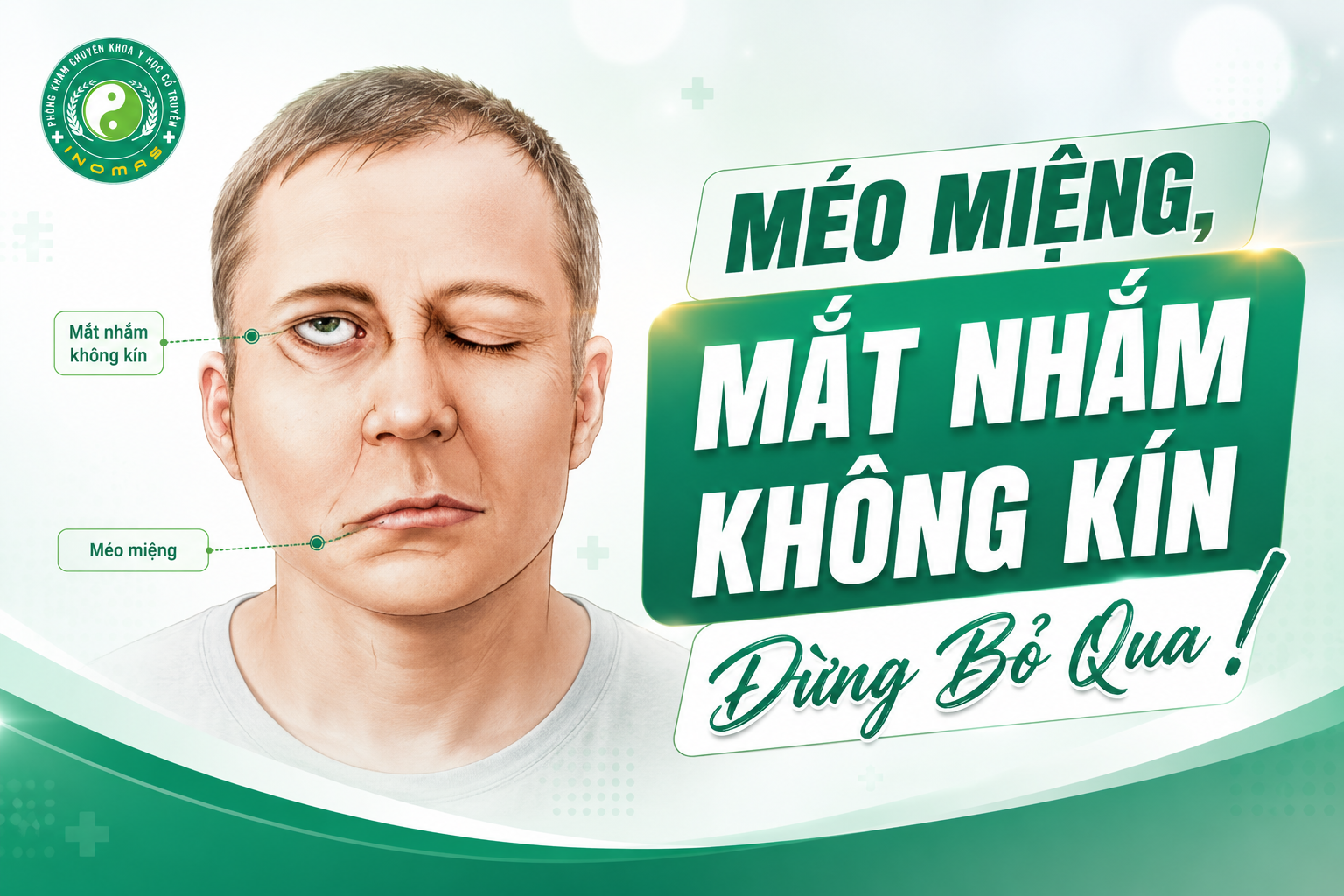 Méo Miệng, Mắt Nhắm Không Kín Đừng Bỏ Qua.