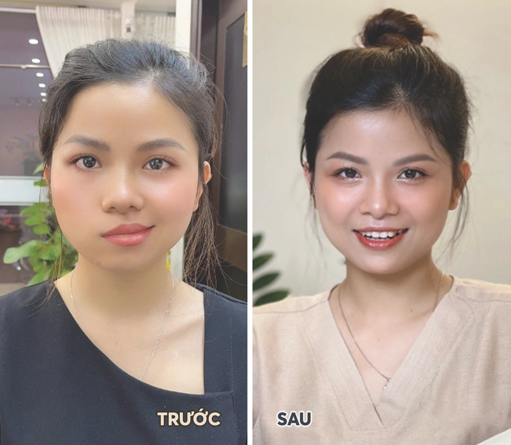 liệt mặt